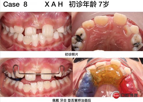 正畸设计方案流程[正畸设计方案流程怎么写]